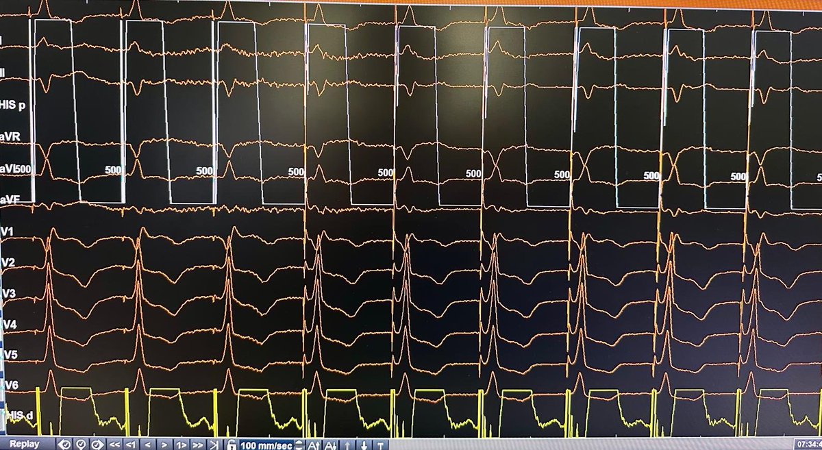 Planning to implant an AVEIR AR in a pt with previous chemotherapy,renal insufficiency,repeated syncope,sinus bradycardia,and CS massage with prolonged sinus arrest.We tested the AV node response to CSM with atrial pacing;this was the response.Finally,we implanted a DDD with LBBP