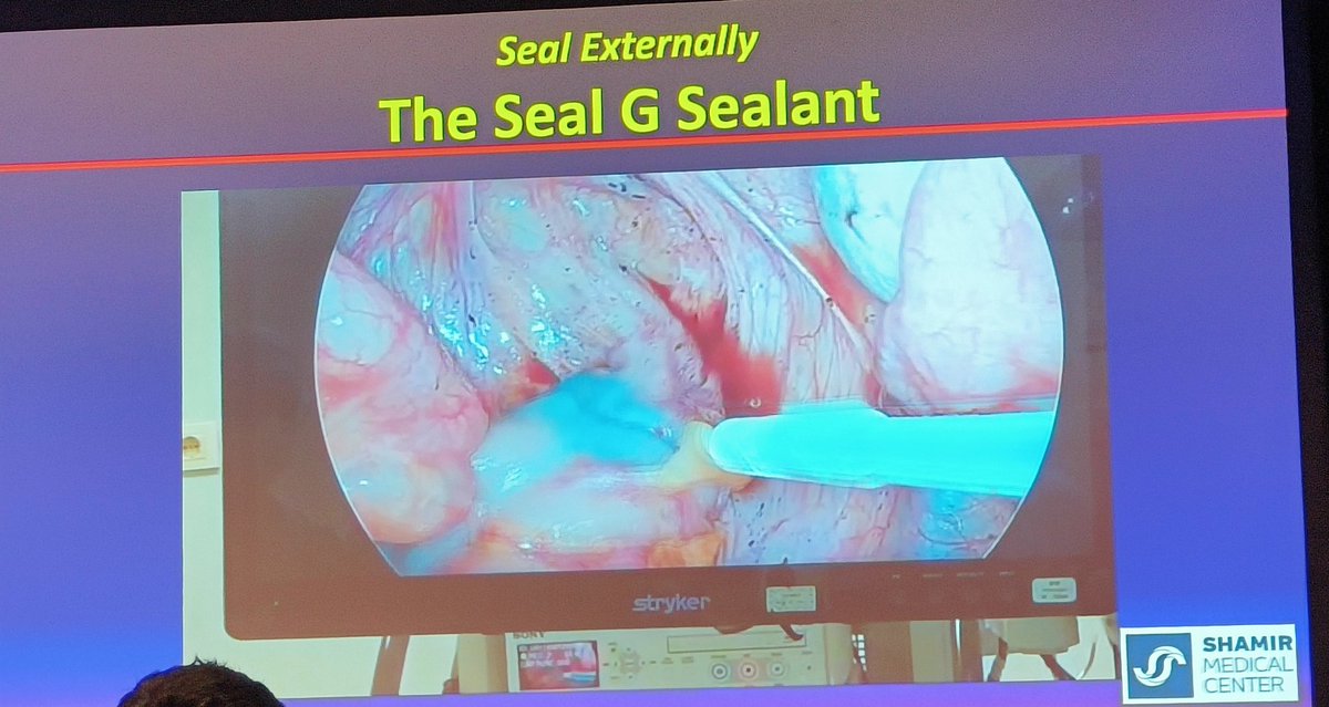 Harish_SurgOnc's tweet photo. Anastomotic Leaks: Where Do We Stand? 🤔
By Oded Zmora
🔹 Nitinol spring –  no evidence
🔹 Reinforcement (Bioabsorbable membrane, glue) – ❌ No benefit
🔹 SealG (Alginate sealant) – 🔬 Pilot study ↓ leaks, needs larger data
📸 Perfusion Imaging:
🔹 Meta-analysis – ICG ↓ to 7.3% https://t.co/MPGhIdfeAu