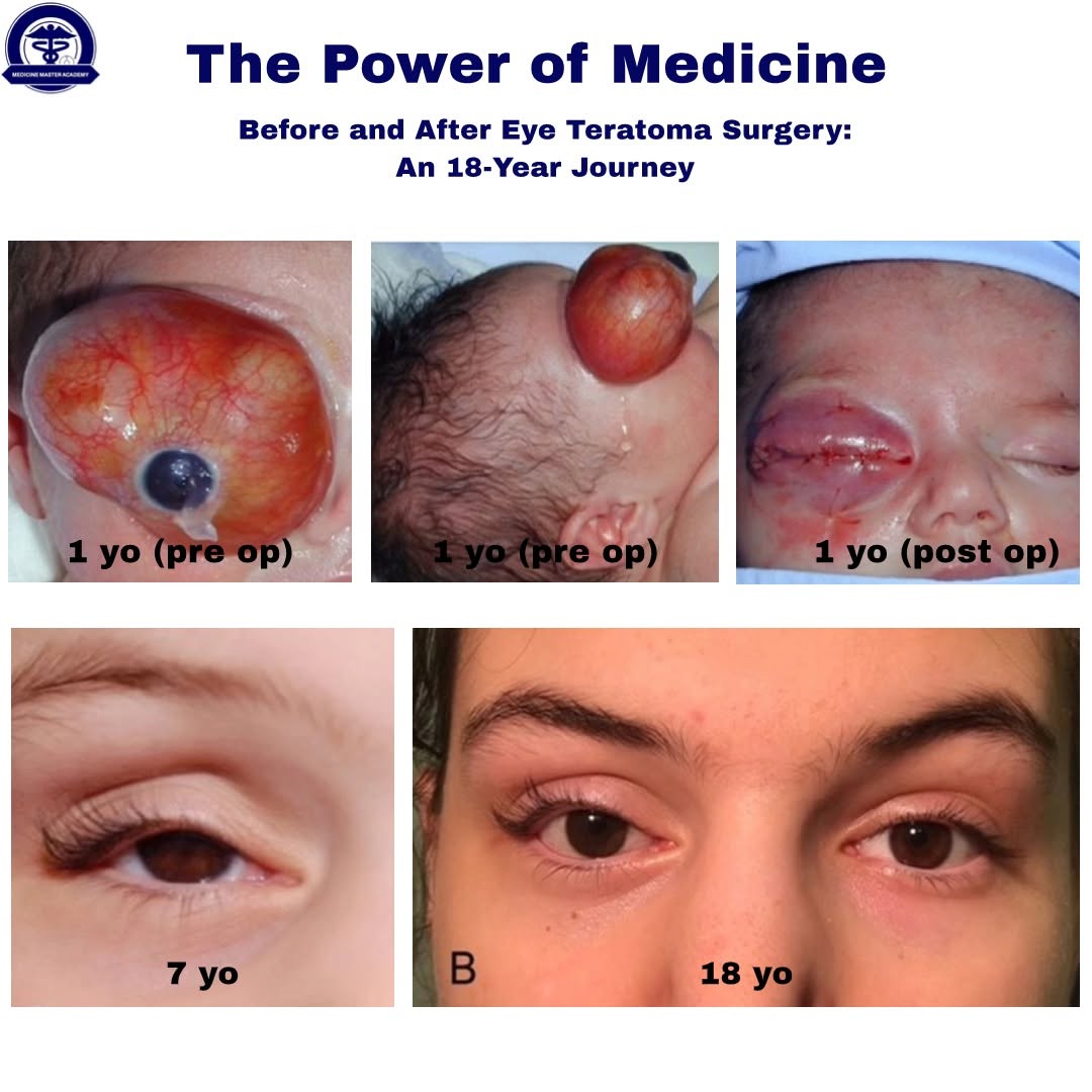 Medicine has the power to transform lives, turning once devastating diagnoses into stories of hope and resilience. 
#teratoma #congenitalteratoma #tumor #ophthalmology #usmle #medicine #health #eyehealth #surgery #eyesurgery #OrbitalTeratoma #PediatricSurgery