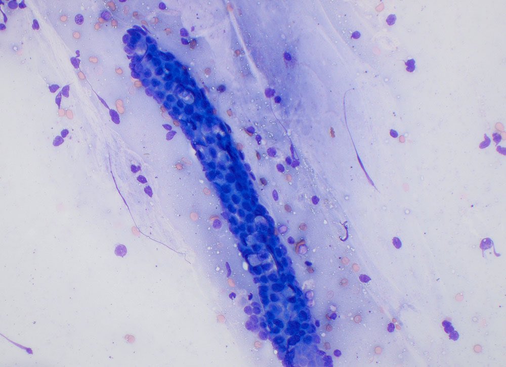 Impression smear of a biopsy of a thickened duodenum in a French bulldog: A villus

Love it when we see tissue architecture in cytologic smears😀