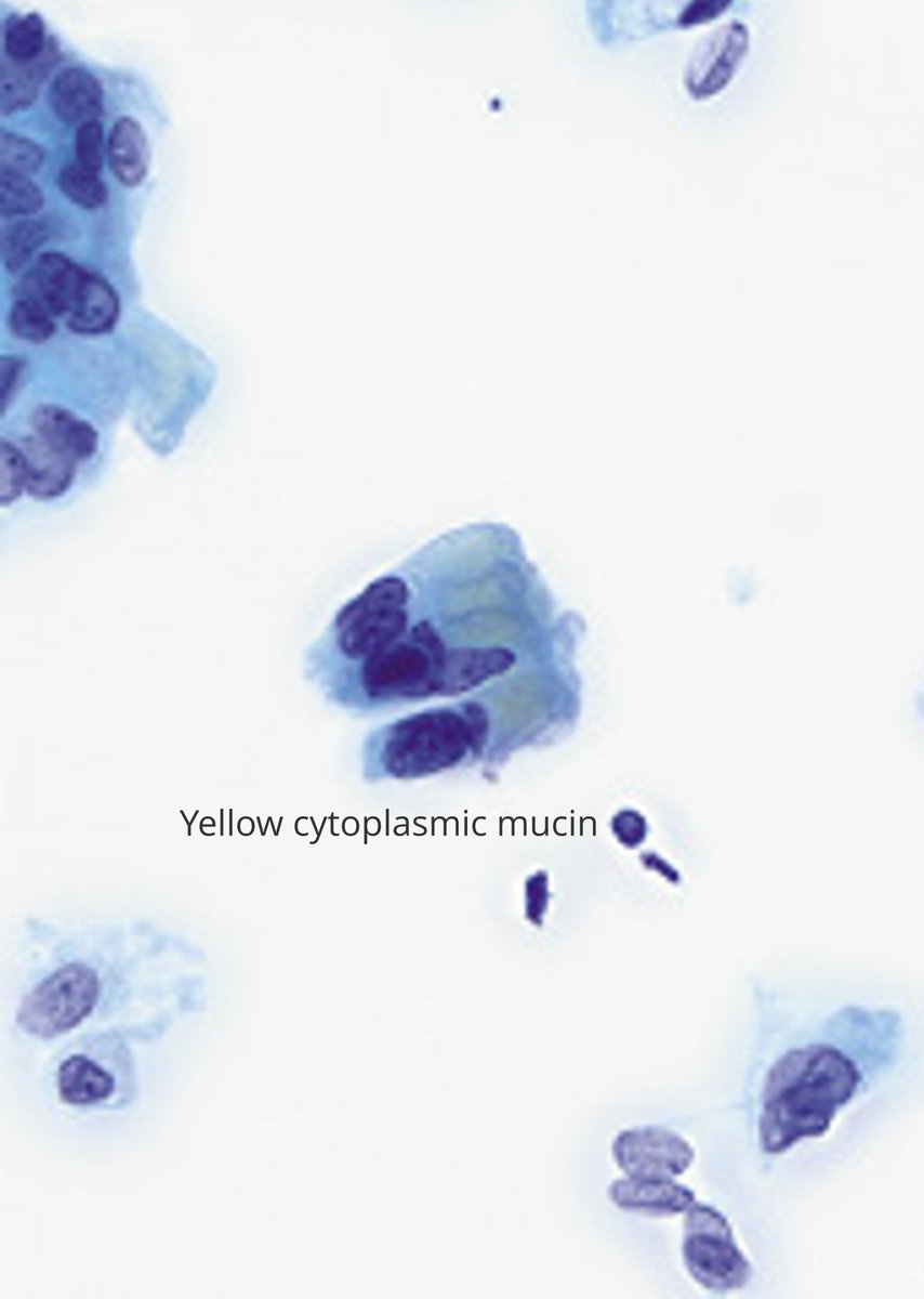 DrCycloPath's tweet photo. HPV-independent adenocarcinoma, gastric-type:
- AKA Adenoma Malignum, Minimal Deviation Adenocarcinoma
- Cytologically very similar to normal endocervix
One study found the following helpful to make the cytologic distinction:
- Microvesicular cytoplasm
- Honeycomb-like sheets
- Prominent nucleoli
- Anisonucleosis
- Characteristic, but rare: yellow cytoplasmic mucin
https://t.co/wPcELq46D1
🔬https://t.co/iw0EJhVkfG
AIS example
https://t.co/Tl7P2fml24
