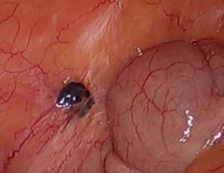 Female patient presents because of irregular and painful menstrual period. Laparoscopy showed these chocolate cysts. What is your diagnosis?
#usmle #laparoscopy #gynecology