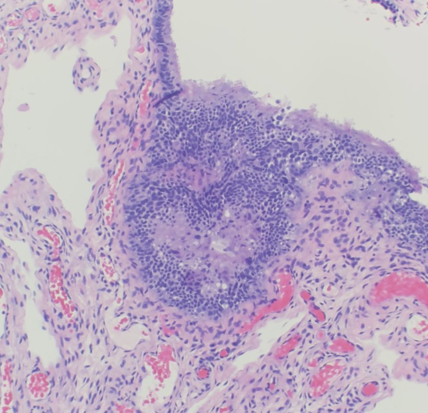 Sameer Andani (@sameerandani) on Twitter photo Thankful to have have been around such warm and innovative folks at #FLPathConf inspiring words by <a href="/DrBuiPathology/">Dr. Bui Pathologist🌼</a> & <a href="/ZhaiJim/">Jim Zhai</a> on our role as trainees in the future of pathology <a href="/FLPathologists/">Florida Society of Pathologists</a> <a href="/USFpathology/">USF Health Pathology</a> Thankful to have have been around such warm and innovative folks at #FLPathConf inspiring words by <a href="/DrBuiPathology/">Dr. Bui Pathologist🌼</a> & <a href="/ZhaiJim/">Jim Zhai</a> on our role as trainees in the future of pathology <a href="/FLPathologists/">Florida Society of Pathologists</a> <a href="/USFpathology/">USF Health Pathology</a>
