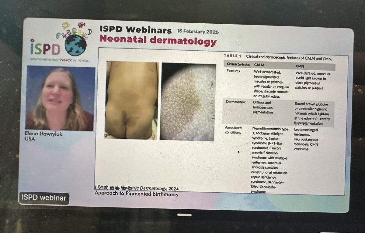 Elena Hawryluk (@elenahawryluk) on Twitter photo Honored to speak at the ISPD webinar on neonatal dermatology this morning on pigmented birthmarks- sharing a collaborative paper with Dr. Seiverling! <a href="/SocietyPedsDerm/">Society for PedsDerm</a> Honored to speak at the ISPD webinar on neonatal dermatology this morning on pigmented birthmarks- sharing a collaborative paper with Dr. Seiverling! <a href="/SocietyPedsDerm/">Society for PedsDerm</a>