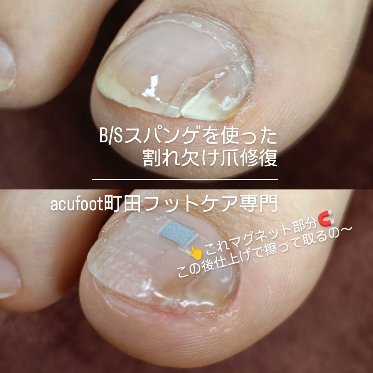 巻き爪BSブレイスクイック　まとめ売り 巻き爪ケア（B/Sブレイス）について | private nail salon omi