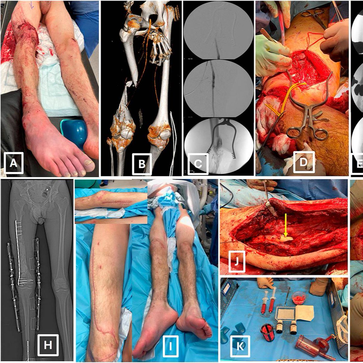 "Modern Management of Severe Open Fractures of the Extremities" Kankaris et al. 

Read online at: tinyurl.com/5ah6zdm8