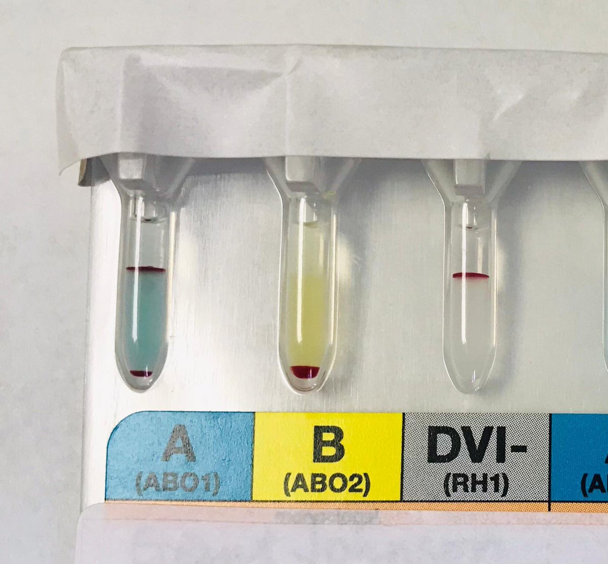 Mixed Field reaction ✨

خلايا تتفاعل وخلايا لا تتفاعل بنفس الوقت هذا يعني وجود نوعين مميزين من الخلايا فينتج عنها اختلاف التفاعل هذا عند المريض. 

وهي لا تعتبر تناقض في ABO
ايش الحالات اللي بنشوف فيها هذا النوع من التفاعل؟💁🏻‍♀️✨