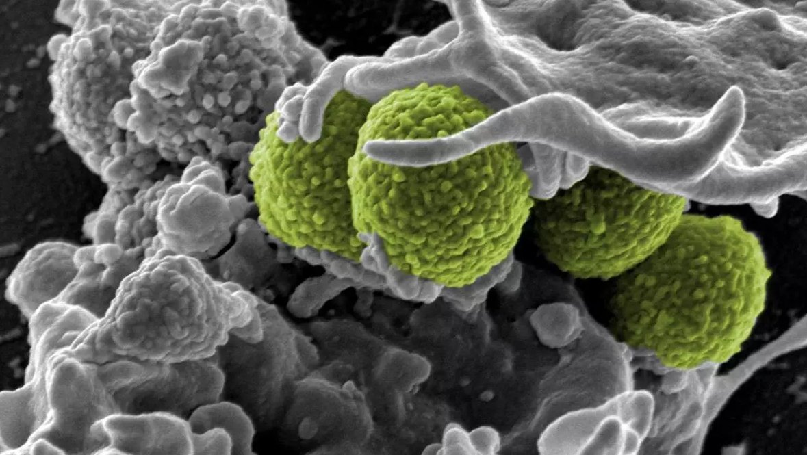 Copo_mur's tweet image. Staphylococcus aureus: así es la bacteria resistente que tanta guerra puede dar en los pies

Nos lo cuenta @periodicoaragon 

elperiodicodearagon.com/salud/guia/202…

#noticias #saludelpie #staphylococcusaureus #bacteriaspies #prevencion #podología #cuidadodelpie