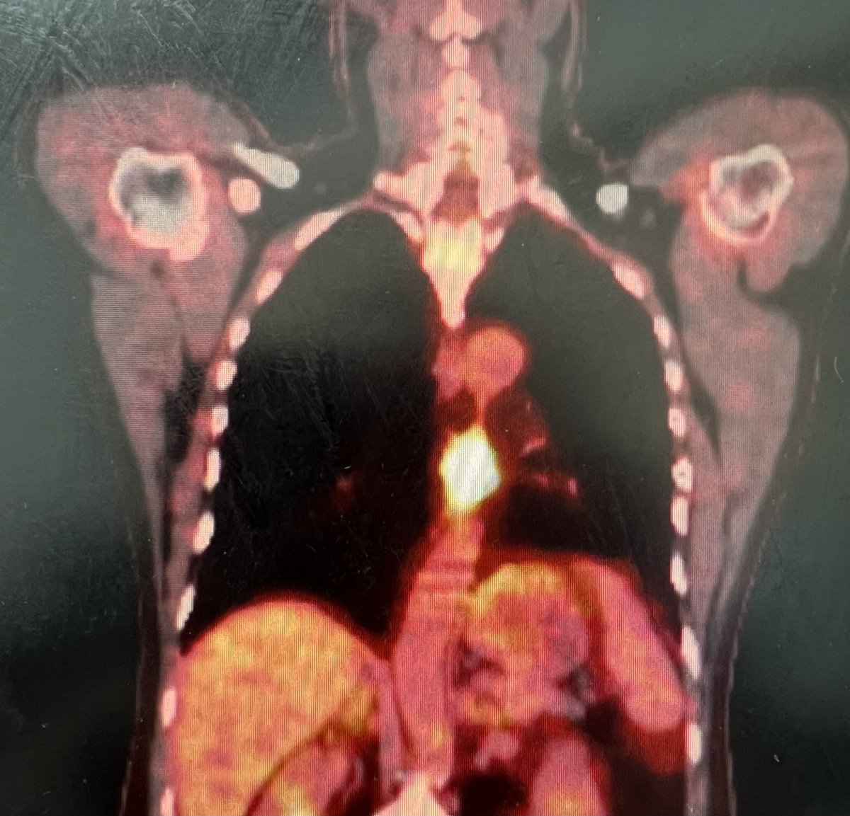 نجاح أول عملية استئصالٍ للمريء لمريض مصاب بالسرطان في مستشفيات المانع بالخُبَر
<a href="/AlmanaHospitals/">مجموعة المانع الطبية Almana Medical Group</a>
alyaum.com/article/6579524