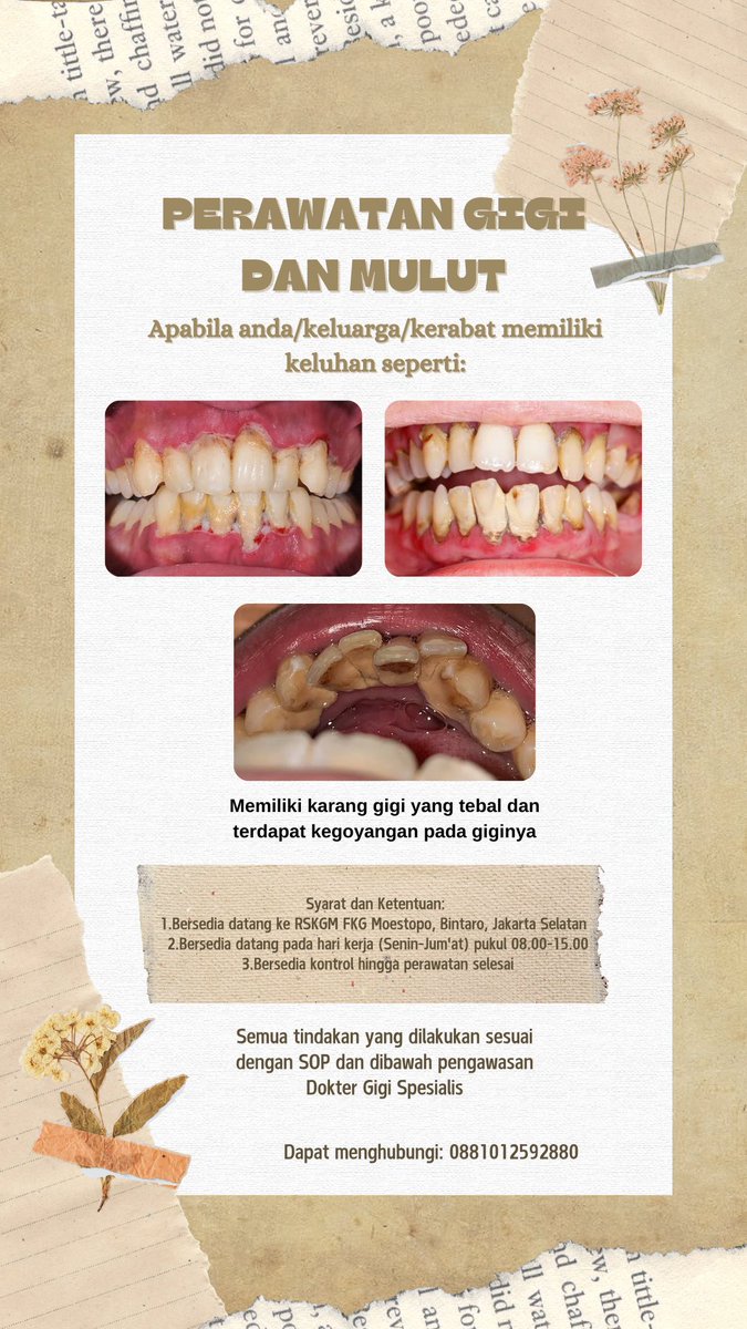 elmocii's tweet image. Hallo semua 👐🏻
Aku lagi cari pasien yang memiliki keluhan karang gigi yang tebal dan terdapat gigi goyang seperti gambar di bawah. Bagi yg berminat dan bersedia untuk dilakukan perawatan boleh langsung dm/wa aku ya 😊✨

#doktergigi #splinting #pasien #koasgigi