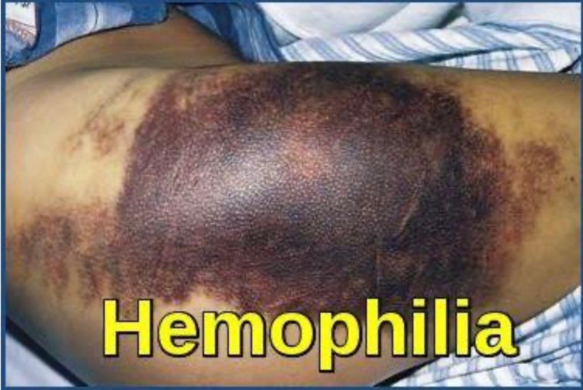 હિમોફિલિયાના દર્દીઓની પડખે ગુજરાત સરકાર:
અમદાવાદ <a href="/civilhospamd/">civilhospitalamdavad</a>  સિવિલ હોસ્પિટલમાં વર્ષ ૨૦૨૪ માં હિમોફિલિયાના દર્દીઓ માટે રૂ.૮ કરોડના ખર્ચે જીવનરક્ષક ક્લોટીંગ ફેક્ટર ઇંજેક્શન પુરા પાડવામાં આવ્યા

<a href="/irushikeshpatel/">Rushikesh Patel</a> <a href="/Dwivedi_D/">Dhananjay Dwivedi</a> <a href="/joshirakesh2016/">Dr. Rakesh Joshi</a>