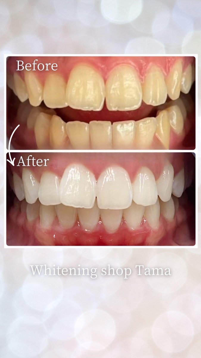 【春のイベントは白い歯で】
ありがとうの日も、さよならの日も…
最高の笑顔でお迎えください🦷💕
今すぐ変われる！！
新しい自分に！！！
お気軽にお問い合わせください🙌
042-610-2270