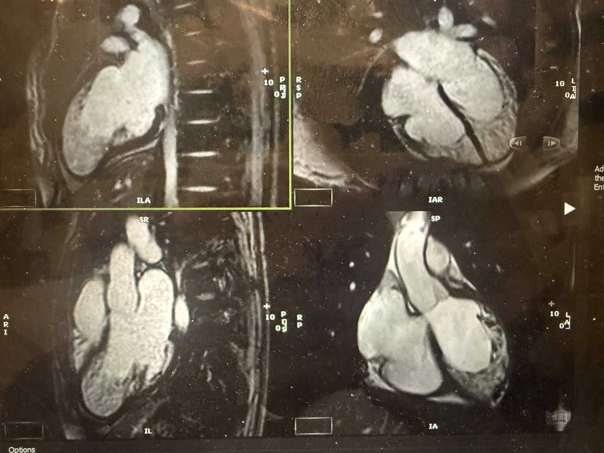 <a href="/AmroAlsaid/">Amro Alsaid, MD</a> <a href="/MansiV1991/">Mansi Verma</a> <a href="/ErsozluSara/">Sara Ersözlü, MD</a> <a href="/danilorenzatti/">Daniel Lorenzatti, MD.</a> <a href="/TiagoSeq/">Tiago Sequeiros</a> <a href="/AnnaGiuliaPavon/">Anna Giulia Pavon</a> <a href="/JSlivnickMD/">Jeremy Slivnick</a> <a href="/RayRcnita/">Nita Ray Chaudhuri, MD, FACC</a> <a href="/AKallifatidis/">Alexandros Kallifatidis</a>
<a href="/AnnaKoulova/">Anna Koulová</a> 
<a href="/LauraVictoria/">Laura Dries</a> 
<a href="/AnamWaheed05/">Anam Waheed, MD</a>

No EGE or LGE