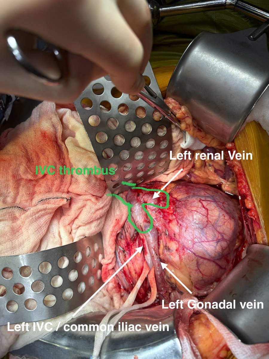 HosamSerag's tweet photo. Sometimes the anatomy is different to what you learnt in medical school ! https://t.co/3iM61QOgVD