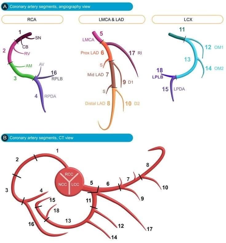 The Heart (@zheart11768530) on Twitter photo ๐ดECG localization of myocardial infarction / ischemia and coronary artery occlusion (culprit) โ๐ฉบโคต๏ธ
ecgwaves.com/topic/localizaโฆ
#Cardiology #FOAMed #MedEd #medstudent #paramedic #Cardiology #CardioEd #medtwitter #meded #CardioTwitter #cardiotwiteros  #MedX #cardiovascular ๐ดECG localization of myocardial infarction / ischemia and coronary artery occlusion (culprit) โ๐ฉบโคต๏ธ
ecgwaves.com/topic/localizaโฆ
#Cardiology #FOAMed #MedEd #medstudent #paramedic #Cardiology #CardioEd #medtwitter #meded #CardioTwitter #cardiotwiteros  #MedX #cardiovascular