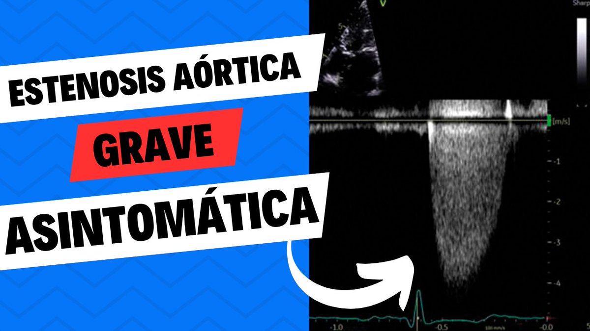 AppCardioNova's tweet photo. Estenosis Aórtica Grave ASINTOMÁTICA ¿Reemplazo valvular o Vigilancia Clínica? 🥼

📜Una publicación del mismísimo Braunwald intenta dar respuesta a esta pregunta.

🧵Dentro hilo

#Cardiologia #MEDICINA #MedEd #eco #Echofirst #POCUS #FOAMed https://t.co/nBgvy1WMrq