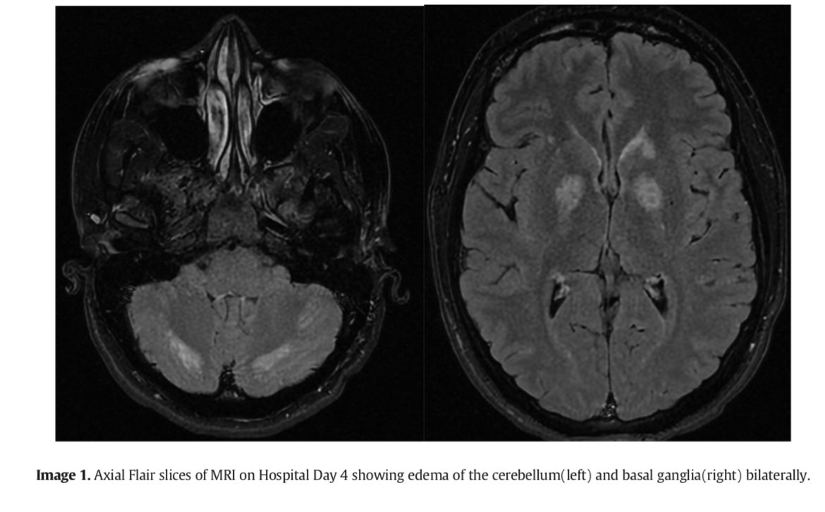 Jed Barash (@jedbarash) on Twitter photo CHANTER spectrum syndrome in Am J Emerg Med
pubmed.ncbi.nlm.nih.gov/39884939/
<a href="/AndrewKofke/">Andrew Kofke</a> <a href="/josh_emncc/">Joshua Madden, MD</a> CHANTER spectrum syndrome in Am J Emerg Med
pubmed.ncbi.nlm.nih.gov/39884939/
<a href="/AndrewKofke/">Andrew Kofke</a> <a href="/josh_emncc/">Joshua Madden, MD</a>