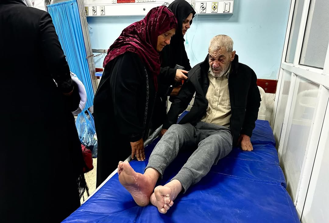 #صور .. أثار التعذيب على الأسـ.ـير المحرر المسن غالب الراضي من شمال غزة، والذي تحرر ضمن صفقة المقاومة