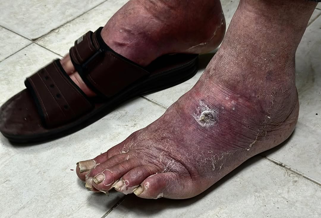 أثار التعذيب على الأسـ.ـير المحرر المسن غالب الراضي من شمال غزة، والذي تحرر ضمن صفقة المقاومة.