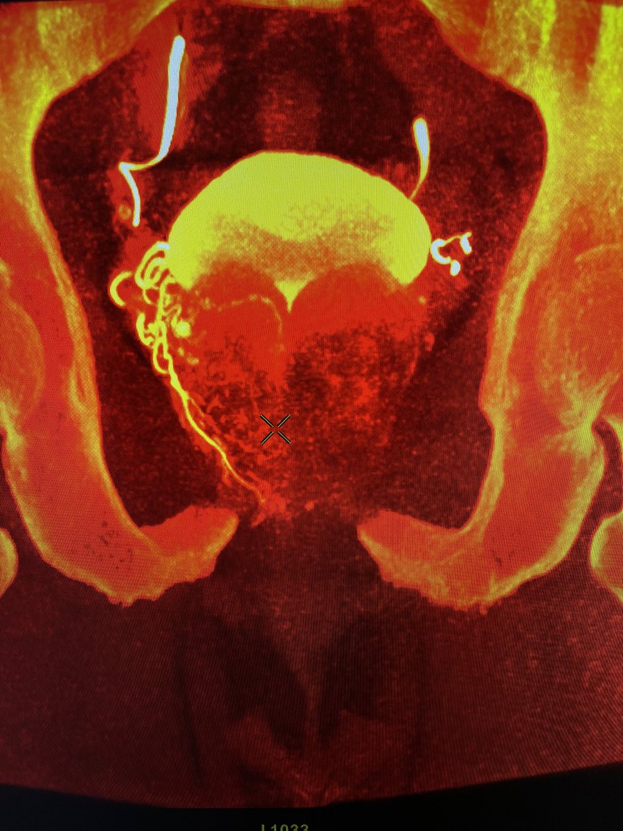Charles Nutting, DO FSIR (@ir_nutt) on Twitter photo Happy Valentines Day from a 100 gram prostate. Coronal cone-beam. Should shrink up to 40% after his prostate embolization Happy Valentines Day from a 100 gram prostate. Coronal cone-beam. Should shrink up to 40% after his prostate embolization