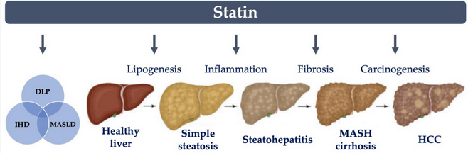 LiversMdpi's tweet photo. #mdpilivers
Welcome to read the paper "Applicability of #Statins in #MetabolicDysfunction-Associated #Steatotic #Liver Disease (#MASLD)".
Free full-text: https://t.co/N9xkn0zcOW https://t.co/OaUfgt6Dj1
