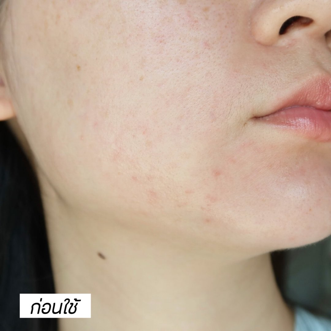 ยืนหนึ่งเรื่องลดสิวต้องให้เค้าแหละ La Roche-Posay Effaclar Duo M+ มอยซ์สำหรับคนผิวเป็นสิวโดยเฉพาะ สิวเราชอบขึ้นตรงบริเวณนี้ เป็นๆหายๆตลอด เลยลองใช้แค่ตัวนี้ตัวเดียว ประมาณเกือบ 2 อาทิตย์ ผลที่ได้คือรอยแดงหายไปเยอะมากก ตรงที่เป็นสิวคันๆ คือยุบไปเลย หน้าตอนนี้คือดีขึ้นมากๆ 🥹 #ใช้ดีบอกต่อ

🛒 https://t.co/fjtwtKY7jX 
🛒 https://t.co/cwYmRXqUeg 

#LaRochePosayTH #Effaclar #ลาโรชโพเซย์ #เอฟฟาคลาร์ #เอฟฟาคลาร์ดูโอพลัสเอ็ม #ลดสิว #รอยสิว #EffaclarDuo #ผิวมัน