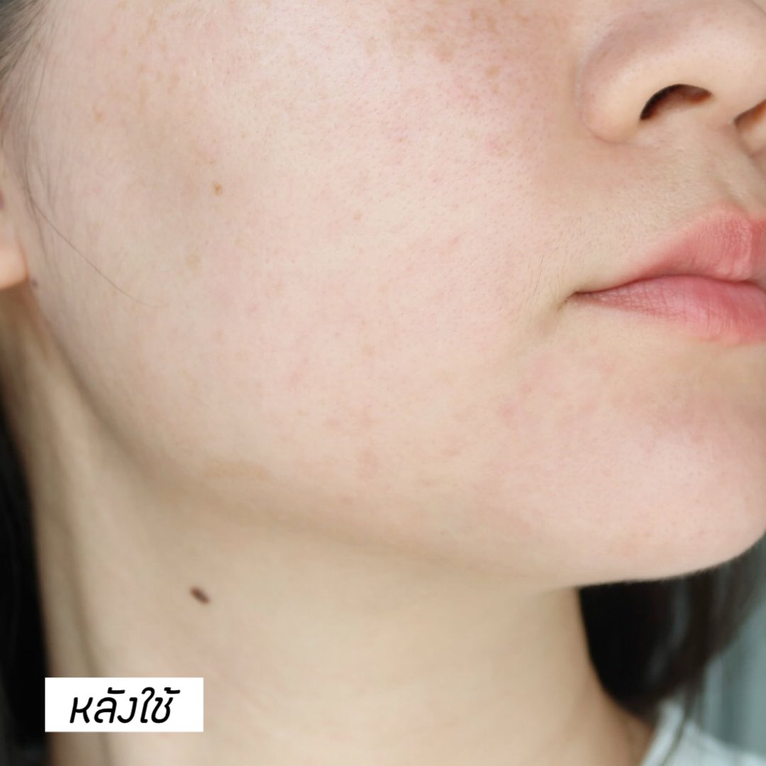 ยืนหนึ่งเรื่องลดสิวต้องให้เค้าแหละ La Roche-Posay Effaclar Duo M+ มอยซ์สำหรับคนผิวเป็นสิวโดยเฉพาะ สิวเราชอบขึ้นตรงบริเวณนี้ เป็นๆหายๆตลอด เลยลองใช้แค่ตัวนี้ตัวเดียว ประมาณเกือบ 2 อาทิตย์ ผลที่ได้คือรอยแดงหายไปเยอะมากก ตรงที่เป็นสิวคันๆ คือยุบไปเลย หน้าตอนนี้คือดีขึ้นมากๆ 🥹 #ใช้ดีบอกต่อ

🛒 https://t.co/fjtwtKY7jX 
🛒 https://t.co/cwYmRXqUeg 

#LaRochePosayTH #Effaclar #ลาโรชโพเซย์ #เอฟฟาคลาร์ #เอฟฟาคลาร์ดูโอพลัสเอ็ม #ลดสิว #รอยสิว #EffaclarDuo #ผิวมัน