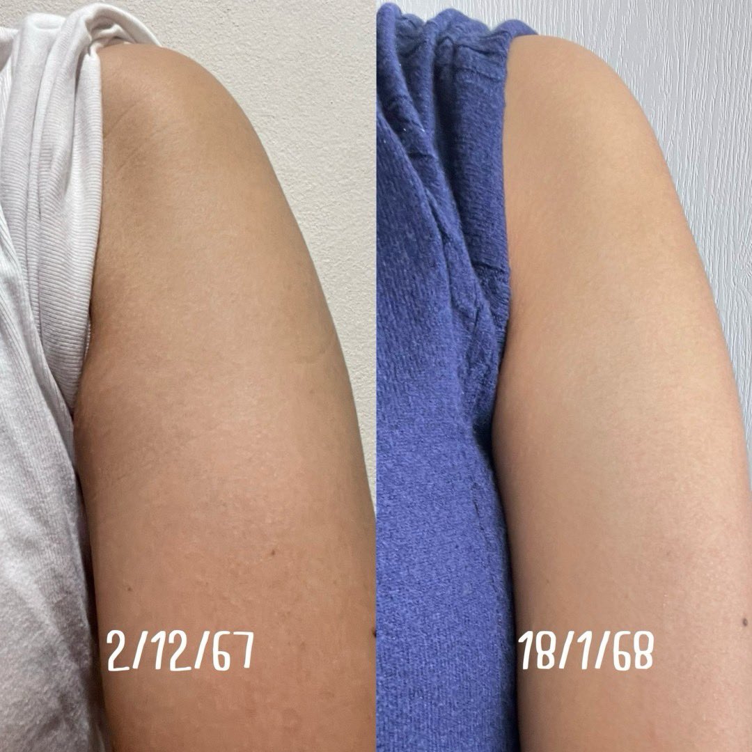 OnppSun_'s tweet photo. ขึ้นแท่นให้เป็นลูกรักเลยสำหรับ Eucerin Spotless Brightening Body Lotion นี่เคยผิวดูหมองมาก ดูคล้ำ ไม่สวย ดูจากในรูปคือเห็นชัดเลย แต่ตอนนี้ทามาตั้งแต่ต้นเดือนจนถึงกลางเดือนมกรา รู้สึกสีผิวดูสม่ำเสมอ ดูเนียนขึ้น ละตัวโลชั่นทาง่ายซึมไวมาก ไม่เหนียวตัวระหว่างวั��� เลิ้บมาก บอกเลยนะทุกคน ปีใหม่ทั้งที ต้องมีต���วช่วยให้ผิวสวยใสจัดเต็ม #Eucerinthailand #โลชั่นผิวขาว #ไทอามิดอลบอดี้โลชั่น
#ใช้ดีบอกต่อ

📍หาซื้อได้ง่ายสะดวกมาก

Watsons : https://t.co/ZM689nJWM7
Shopee : https://t.co/JN2lsTWgaR
LZD : https://t.co/J78luHdTpp
Eucerin Website : https://t.co/ZYH3SMaWKu