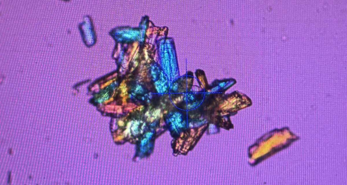 Oriol Angerri (@oangerri) on Twitter photo The beauty of crystalluria and very important clinical factor <a href="/Silvia_Gracia/">Sílvia Gràcia-Garcia</a> <a href="/FPuigvert/">Fundació Puigvert Barcelona</a> The beauty of crystalluria and very important clinical factor <a href="/Silvia_Gracia/">Sílvia Gràcia-Garcia</a> <a href="/FPuigvert/">Fundació Puigvert Barcelona</a>
