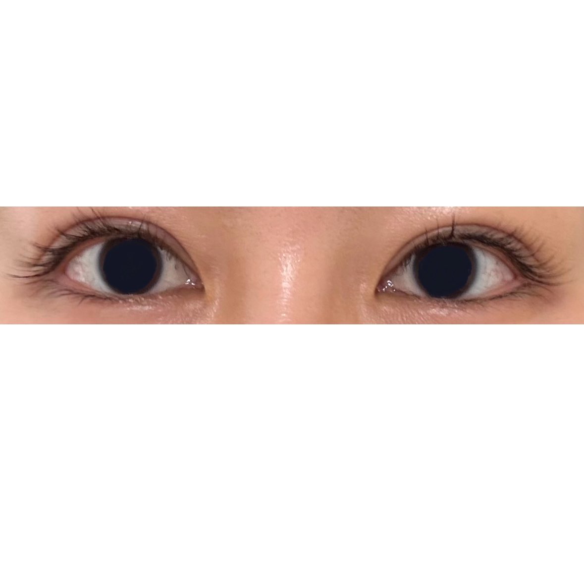 halfjsg's tweet photo. 修正カウセ終わり！聞きたいこと聞けて満足なカウセでした！今のところ第一候補。この左右差でもう数ヶ月過ごさなきゃ行けないのか😭今月はあと１つカウセ行く予定🏃 https://t.co/q5fNypypHe