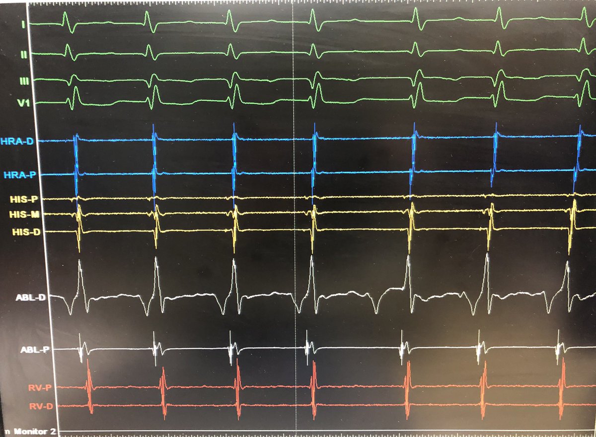 javadm20's tweet photo. Earlier switch to the left is a preferred approach in recurrent / failed AVNRT ablation! This case had 2 times failed ablation! Did Slow ( LIE) abl. here👇! #Epeeps https://t.co/xy0yxKZAvt