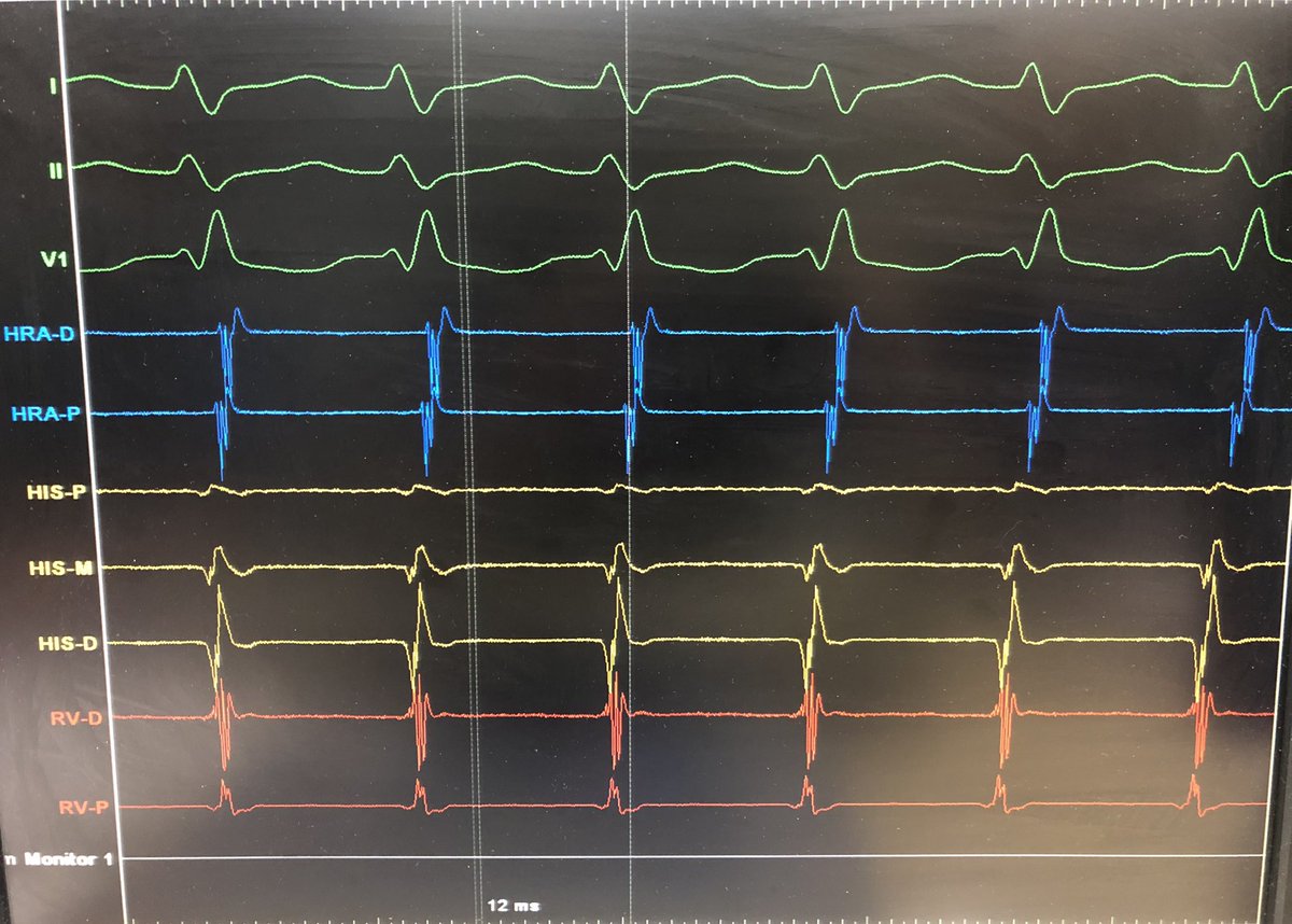 javadm20's tweet photo. Earlier switch to the left is a preferred approach in recurrent / failed AVNRT ablation! This case had 2 times failed ablation! Did Slow ( LIE) abl. here👇! #Epeeps https://t.co/xy0yxKZAvt