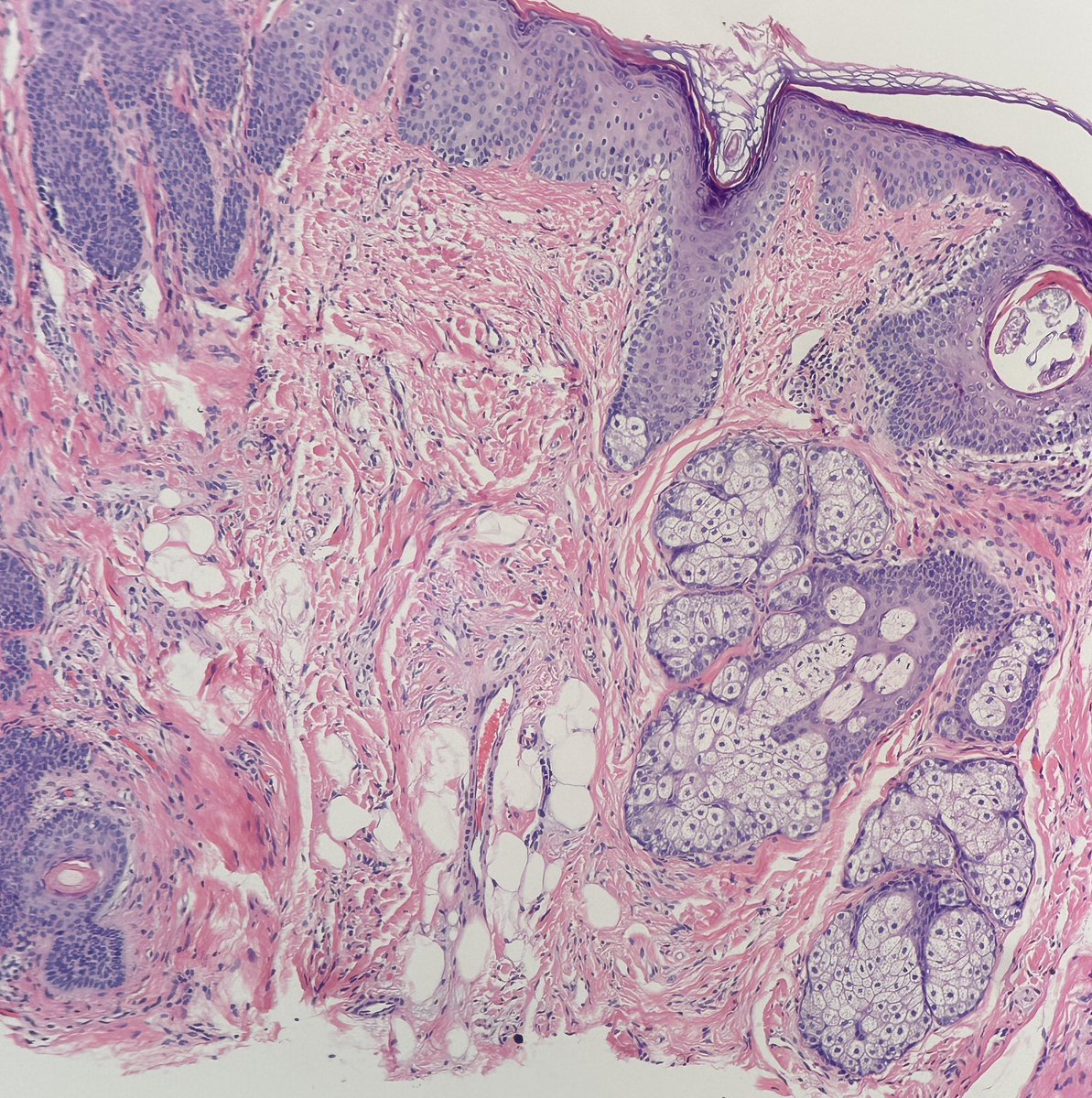 Henry YANG (@henryy_md) on Twitter photo #dermpath
I think we discussed this before but forgot whatâs the consensus. For this nasal lesion, would you call it SCL or Trichodiacoma? <a href="/mccalmo/">Tim McCalmont</a> <a href="/david_terrano/">David Terrano</a> <a href="/tonitatirado/">Mariantonieta Tirado</a> <a href="/gonzadetoro/">Gonzalo De Toro</a> <a href="/et565/">Etan Marks, DO</a> <a href="/RACARR51/">Richard Carr</a> <a href="/MarcelaSaebL/">Marcelasaeblima.</a> #dermpath
I think we discussed this before but forgot whatâs the consensus. For this nasal lesion, would you call it SCL or Trichodiacoma? <a href="/mccalmo/">Tim McCalmont</a> <a href="/david_terrano/">David Terrano</a> <a href="/tonitatirado/">Mariantonieta Tirado</a> <a href="/gonzadetoro/">Gonzalo De Toro</a> <a href="/et565/">Etan Marks, DO</a> <a href="/RACARR51/">Richard Carr</a> <a href="/MarcelaSaebL/">Marcelasaeblima.</a>