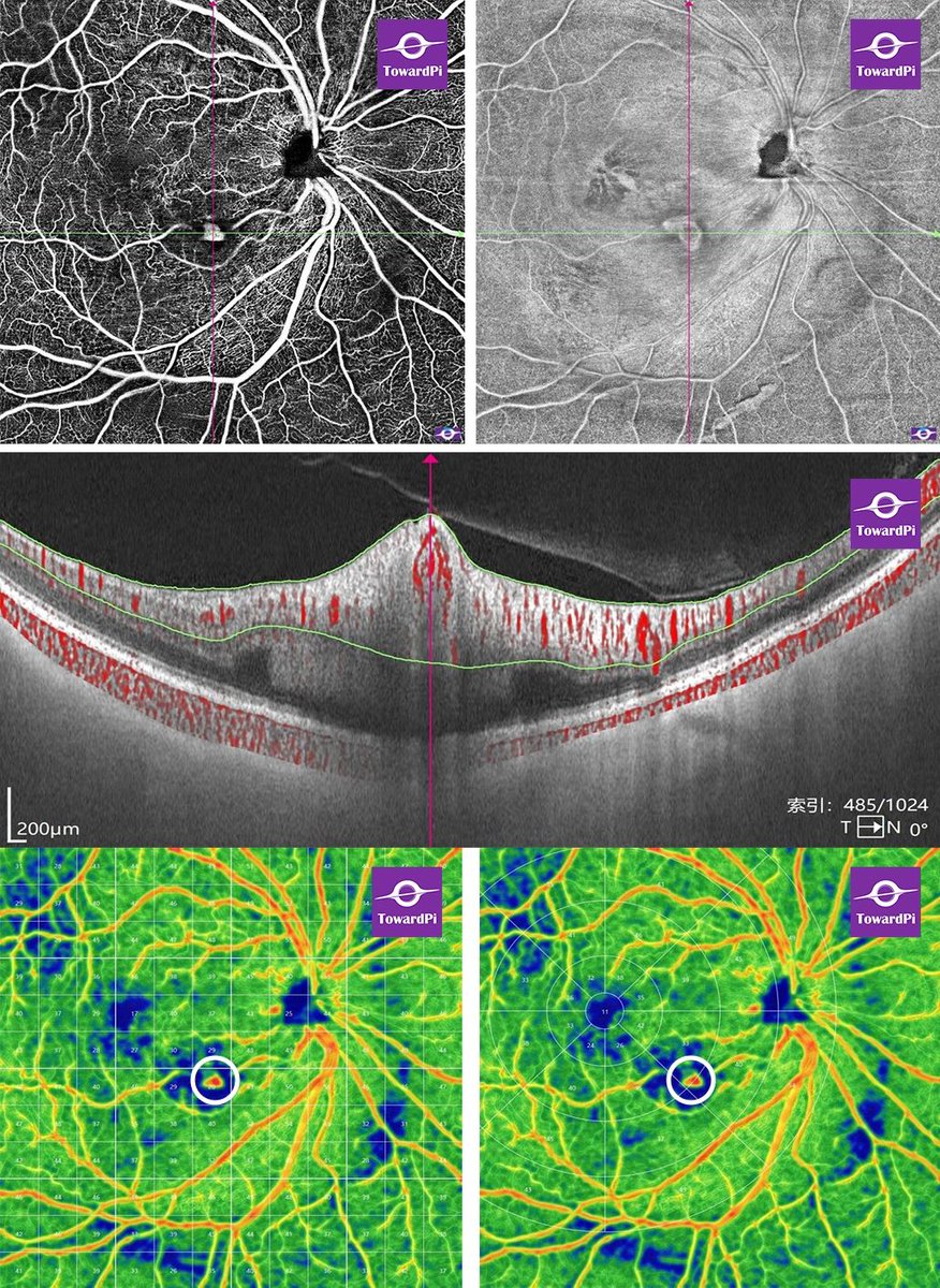 toward_pi's tweet photo. Retinal Macroaneurysm revealed by 3D full range SS-OCTA! An 82-year-old female who had a history of arteriosclerosis complained vision loss in her right eye...Read more: https://t.co/98ihxFTIAV
#ophthalmology #SSOCT https://t.co/8k3FHnmn22