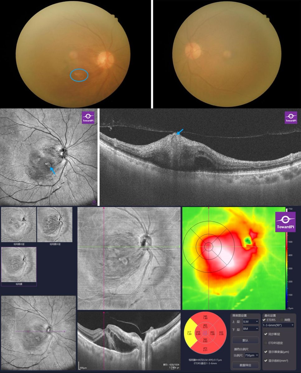 toward_pi's tweet photo. Retinal Macroaneurysm revealed by 3D full range SS-OCTA! An 82-year-old female who had a history of arteriosclerosis complained vision loss in her right eye...Read more: https://t.co/98ihxFTIAV
#ophthalmology #SSOCT https://t.co/8k3FHnmn22