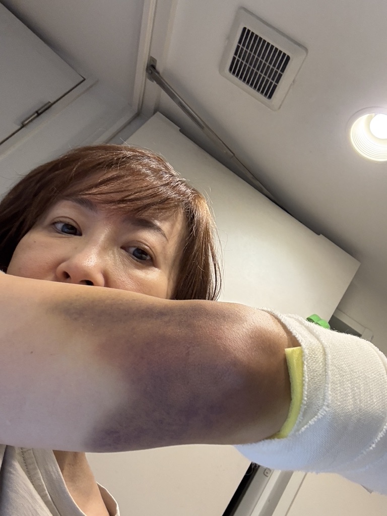 haramotomiki's tweet photo. 右手首骨折〜入院〜手術〜退院

多くの方にご心配いただきました。
なんとか手術も終わり、退院、ギブスが取れました。

そもそもは土曜日の深夜に椅子でうたた寝し、足が痺れたため立ちあがろうとした拍子にひっくり返ったことでした。

瞬間天地が逆さまになって手首にボキッ！と音がしたのではないかと思うほどの衝撃で、「ギャーア！」と叫びました。

足が小さくて（22㎝）よく転ぶのですが、これまで骨折やヒビも入ったことがなかったのが自慢でした。でも今回ばかりはすぐに「あ、これ骨逝ったな」と分かりました。
だって、手首の腫れ方が異常なんですもの。そして痛みで急に気持ち悪くなって吐きました。

夫が駆けつけてくれ、「7119」に電話をすると、救急車呼ばなかったので、病院の電話番号をいくつか案内され自分で探すんですね。
3軒目で整形外科医が宿直の病院を見つけ、夜間救急外来に駆け込みました。

レントゲン、CT撮って「右手首の橈骨遠位端骨折」と診断されました。
手首の骨折は【骨折三兄弟】と呼ばれるくらい多いとか。

「ちょっと骨の位置ズレてるので『整復』しますね」
と先生が言って、私の手首に麻酔をしたと思ったらものすごい力で握ってギュッ、ギュッ、ギュ〜！
と骨を動かそうとした。

ギャーア！！！

骨折したとき以上の叫び声が深夜の病院に��き渡り、私はショックで全身ガタガタ震え出した。

「これで骨の位置が元に戻れば良いのですが、数日様子を見てダメだったら…」

ダメでした。

金属プレートを手首に埋め込む手術となりました。

その方が治りも早く、手首の可動域も広くなるそうなので、迷わず手術を決めました。

入院準備で一番大変だったのは、ネイルを落とすことでした。
全身麻酔をするので、指先で色々チェックするんですよね。
手と足のジェルネイル、付けたばかりなのに、ネイルサロンの方のご厚意で予約が取れ、残念ですが全部落としました(泣)

手術当日、ドラマで見るような目が眩むほどの照明の手術台に乗せられ、全身麻酔をかけて…、目が覚めたら病室のベッドで寝ていました。

無事終わったそうです！

しかし新たな地獄の始まり。
夜中に麻��が切れてから、腕が浮腫んでギプスが食い込み痛いの��んの！！（血が出てだぞ！）
深夜3時から朝8時までのたうち回り、二昼夜続いた頃、なんか見回りに来た新人ナースさんが包帯緩めてくれた途端やっと息がつけるようになりました。

あんなに入院準備したのに、結局風呂キャン。
ずっとベッドでiPadで撮り溜めた「坂の上の雲」「八甲田山」「二百三高地」を観て、余計に暗澹たる気持ちになってました。

退院後、1週間で「じゃ、リハビリ始めてください」。
は？
あんなに固めてたのに、今度はいきなり動かすの？無理無理無理。

次の地獄の始まり。
リハビリ室で、ちょっと手首の角度を変えるだけで怖くて全身震えました。今も腕の角度によって激痛が走ります。
また、指が使えない代わりに肘で押さえたりしてたら、尋常じゃない青アザ！
本当に治るんかいな。←イマココ

#骨折