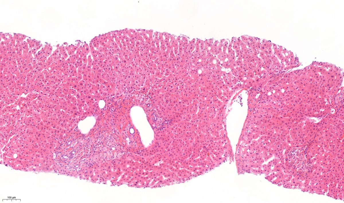 Silicosis hepática como causa infrecuente de enfermedad granulomatosa hepática. elsevier.es/es-revista-gas…