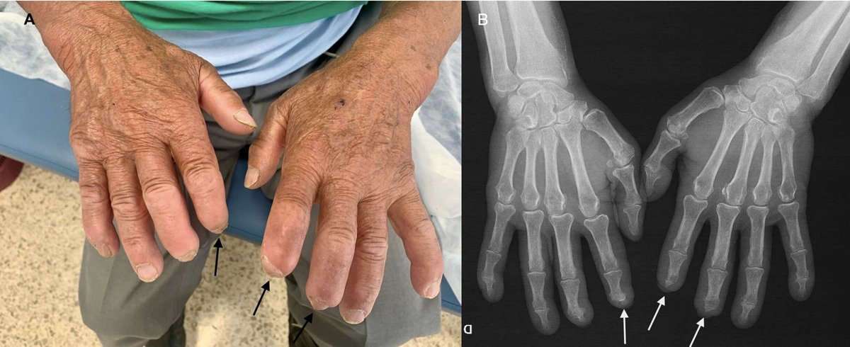Síndrome del túnel carpiano: variedad ulcerativa-mutilante. elsevier.es/es-revista-med…