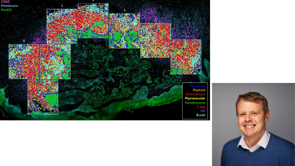 Hat’s off to our January #ResearchisBeatuiful pick!

Matt’s image depicts a cutaneous squamous cell carcinoma infiltrating into the dermis.

Read on to hear more about Matt’s work and the story behind his image. 👉tinyurl.com/3f4wbfx8

<a href="/bottomleymatt/">Matt Bottomley</a> | <a href="/CAMS_COI_Ox/">CAMS Oxford Institute</a>