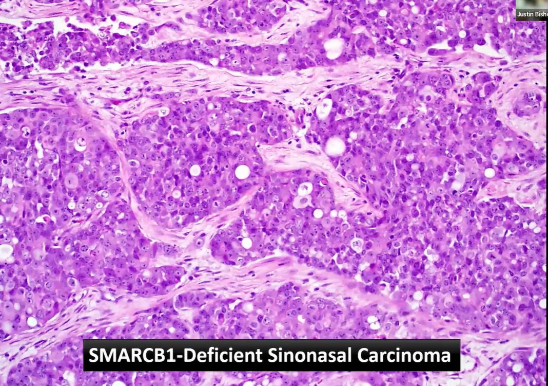 Janiranavarro's tweet photo. SMARCB1-Deficient Sinonasal Carcinoma
Morphologic clues
-Empty vacuoles (unknown mechanism)
-Tumoral sheets and nests with frequent necrosis

Dr. Bishop ISIMm #pathology #PathX #PathTwitter