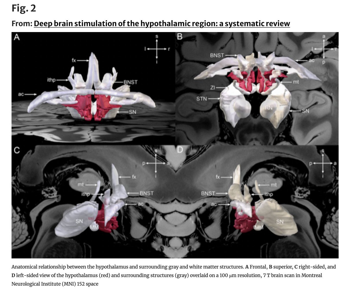 Neuro_IC's tweet photo. Congratulations to our team for their latest #Neurosurgery publication @DrMofatteh #AbdulkadirMohamed @msmashayekhi @GSkandalakis @c_neudorfer @saman_arfaie @m_m_sbh @RabiiAboulhosn #XuxingLiao @andreashorn_  &amp; Prof. Keyoumars Ashkan

🔽
https://t.co/DEdgYHXBFN

@ActaNeuro https://t.co/ElOBKUGnSc