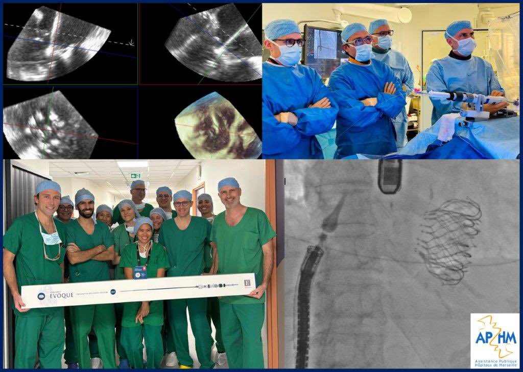 deharo_pierre's tweet image. First cases of TTVR with the EVOQUE valve in CHU La Timone Marseilles - game changer for patients ineligible for TEER - smooth procedure with impressive results 🙏 @CHUdeMarseille @JrmyBoyer8 @SFCardio @CuissetDr @PCRonline @GRCIcardio