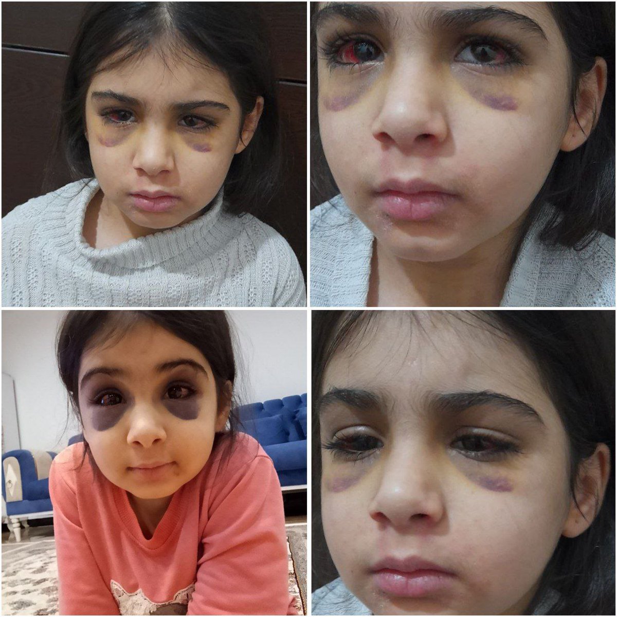 ⚠️🔻 Sîne'li 9 yaşındaki kız çocuğuna işkence.

 🔹 9 yaşındaki kız çocuğu Anila, üvey annesinin en ağır fiziksel ve zihinsel istismarına maruz kaldı  

 🔹Vücudunda ve kafasında yara izi bulunan ve hatta okul personelini defalarca ziyaret eden bir çocuk, artık konuyu takip +