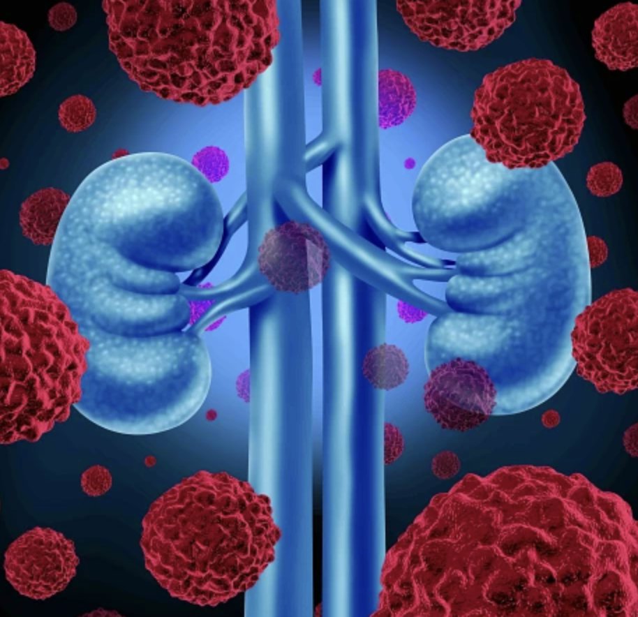 Dana-Farber News (@danafarbernews) on Twitter photo Successful anti-cancer immune responses reported in phase 1 trial of a personalized cancer vaccine for #kidneycancer. Research in <a href="/Nature/">nature</a> led by <a href="/DrChoueiri/">Toni Choueiri, MD</a> #PatrickOtt #CatherineWu #DerinKeskin (all of <a href="/DanaFarber/">Dana-Farber</a>) and <a href="/BraunMDPhD/">David Braun</a> of <a href="/YaleCancer/">Yale Cancer Center</a>
ā”ļø bit.ly/3CDIT3n Successful anti-cancer immune responses reported in phase 1 trial of a personalized cancer vaccine for #kidneycancer. Research in <a href="/Nature/">nature</a> led by <a href="/DrChoueiri/">Toni Choueiri, MD</a> #PatrickOtt #CatherineWu #DerinKeskin (all of <a href="/DanaFarber/">Dana-Farber</a>) and <a href="/BraunMDPhD/">David Braun</a> of <a href="/YaleCancer/">Yale Cancer Center</a>
ā”ļø bit.ly/3CDIT3n