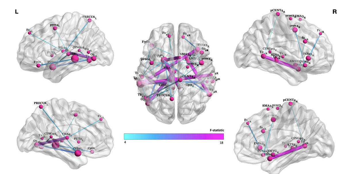 New #preprint out🧠 

“Distinct patterns of structural connectivity are associated with variations in language lateralisation.”

biorxiv.org/content/10.110…