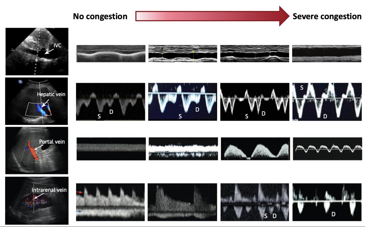 GallooX (@xgalloo) on Twitter photo Happy to be invited in this first module in new series of the London Postgraduate course in Heart Failure to speak about the echographic assessment of congestion. Evaluation can be very clear, yet sometimes requiring a multiparametric approach!#PCHFLondon <a href="/zhh_ch/">Zurich Heart House (ZHH)</a> Happy to be invited in this first module in new series of the London Postgraduate course in Heart Failure to speak about the echographic assessment of congestion. Evaluation can be very clear, yet sometimes requiring a multiparametric approach!#PCHFLondon <a href="/zhh_ch/">Zurich Heart House (ZHH)</a>