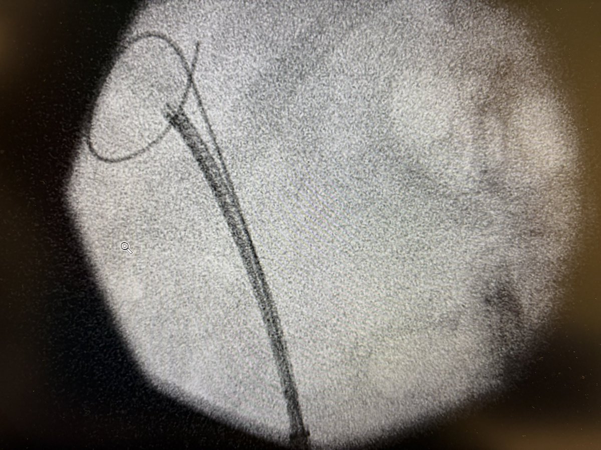 Ben Dreyer (@ben_dreyer_) on Twitter photo Vital to have the right tools for the job! Lumenis P120 for a whopping 300cc HoLEP & speedy morcellation with the Wolf Piranha. Followed with the great dusting power of TFL Drive to clear a 1.5cm renal stone in <1h! #holep #BPH <a href="/RichardWolfGmbH/">RichardWolfGmbH</a> <a href="/bsc_urology/">Boston Scientific Urology</a> <a href="/Coloplast_MD/">Coloplast Interventional Urology</a> Vital to have the right tools for the job! Lumenis P120 for a whopping 300cc HoLEP & speedy morcellation with the Wolf Piranha. Followed with the great dusting power of TFL Drive to clear a 1.5cm renal stone in <1h! #holep #BPH <a href="/RichardWolfGmbH/">RichardWolfGmbH</a> <a href="/bsc_urology/">Boston Scientific Urology</a> <a href="/Coloplast_MD/">Coloplast Interventional Urology</a>