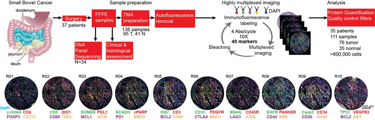 A spatially resolved single cell proteomic atlas of Small Bowel Adenocarcinoma. 
A major resource for a rare cancer; ~600K cells; spatial  immune features in tumor and matched normal niches may predict survival
 #spatialbiology #highlymultiplexedimaging
biorxiv.org/content/10.110…