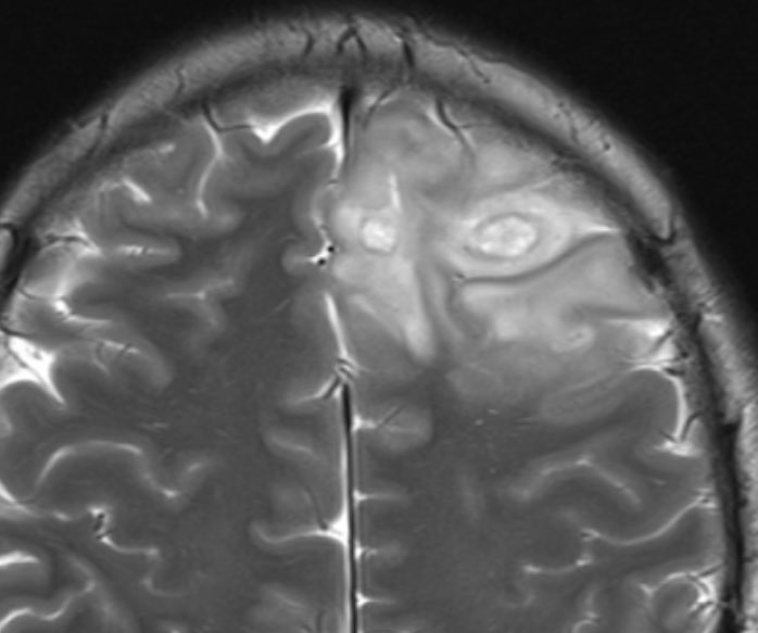 todays surgery

🧵 Grade 2 Astrocytomas: 2021 WHO CNS Tumor Classification Updates &amp; Clinical Insights

1/ What are Grade 2 Astrocytomas?
These are diffuse, infiltrative gliomas categorized as WHO Grade 2 with malignant potential. They primarily affect young adults (20–40 years)