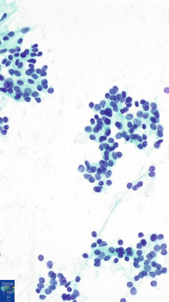 DrCycloPath's tweet photo. AUS featuring __ atypia 
A) architectural
B) nuclear
C) architectural &amp; nuclear
#Thyroid #CytoPath #Pathology #PathTwitter https://t.co/SrHe38WzGb